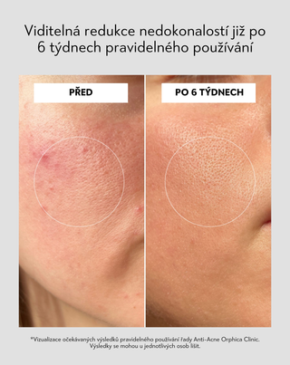 Denní krém proti akné s kyselinou salicylovou a azelaovou Anti-Acne Orphica Clinic 50 ml - 5