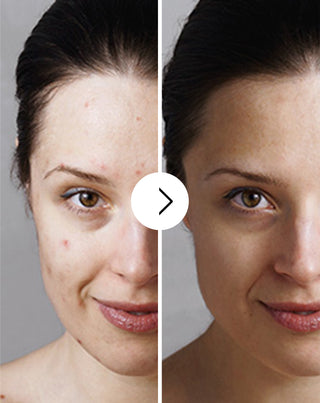 Tablety na akné, pupínky a nedostatky se zinkem, vitamíny C, E a B2 Derminax_3 - 3