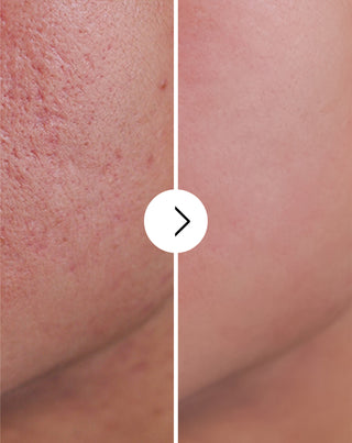 Tablety na akné, pupínky a nedostatky se zinkem, vitamíny C, E a B2 Derminax_3 - 4