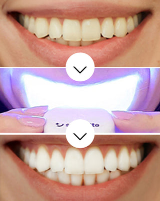Sada na bělení zubů s LED lampou a bělícím gelem Light & Bright Smilebite