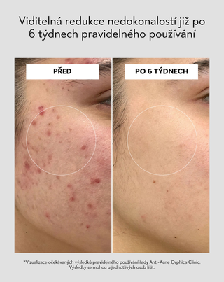 Pleťový peeling s niacinamidem, panthenolem, BHA a mikrogranulemi Anti-Acne Orphica Clinic 100 ml - 5