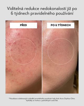 Pleťové tonikum s niacinamidem a kyselinou azelaovou Anti-Acne Orphica Clinic 200 ml - 6