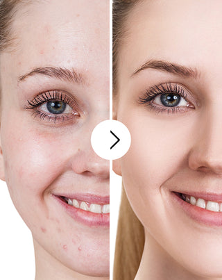 Tablety na akné, pupínky a nedostatky se zinkem, vitamíny C, E a B2 Derminax_5 - 5